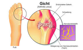 Was Ist Gicht Und Wie Kann Man Die Krankheit Behandeln