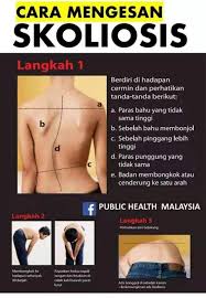 Cara Mengesan Tulang Bengkok A K A Rawatan Tulang Belakang Urut Saraf Kl Facebook