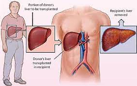 A transplanted liver may be more sensitive to damage by chemicals, including alcohol. All You Need To Know About Liver Transplantation