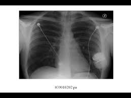 0 ratings0% found this document useful (0 votes). Advantages And Limits Of S Icd Therapy Bodossaki Lectures On Demand