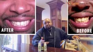 How To Whiten Your Teeth Natural And Long Term Results 100 Safe And Effective Youtube