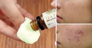 10 Reasons You Should Put Tea Tree Oil On Your Skin Right Now Fit Happy Week Tea Tree Oil Tea Tree Oil Skin Melaleuca Oil