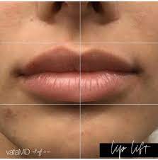 Lasertouch aesthetics, which offers fillers, botox, and skin tightening, offers coolsculpting. Studiomd 26 Photos 29 Reviews Skin Care 16 Church St White Plains Ny Phone Number Services Yelp