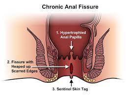 Fisura Anal | ASCRS