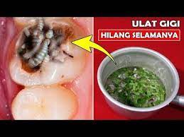 Berkumur dengan air garam juga dikenal sebagai cara atasi sakit gigi berlubang secara alami sejak lama. Hanya 5 Menit Sakit Gigi Sembuh Total Cara Mengeluarkan Ulat Gigi Secara Alami Jihan Alia Youtube Kesehatan Gigi Pemutih Gigi Alami Obat Alami