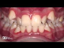 Finden sie invisalign cost in ihrer nähe. How Much Do Braces Cost For Adults And Teens Find Out Now