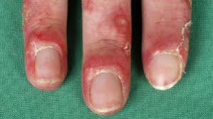 Image result for Chilblains