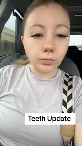 I should stop calling these invisalign, they’re Spark Clear Aligners 😅  Week 1, tray 1 update #straightteethjourney #adultorthodontics  #sparkaligners