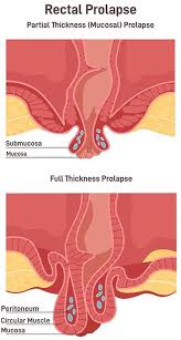 Image result for Rectal prolapse