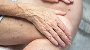 Image result for liver spots on legs