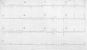 Image result for Rest Tremor