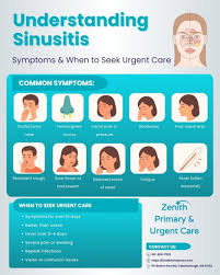 Image result for Sinusitis Prediction Rule