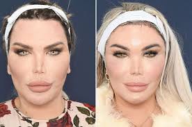 2015 may cited 2016 mar 18; Facial Feminization Surgery Tracheal Shave Removing The Adam S Apple 2pass Clinic
