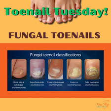 Image result for Pitting nails feet