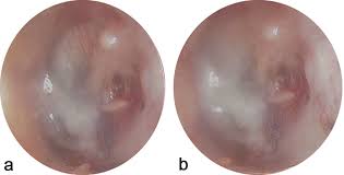 Image result for Myringosclerosis