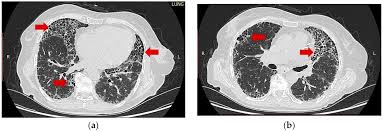 Image result for XRay Changes in Rheumatic Conditions