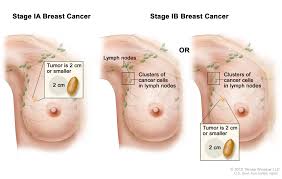 Image result for Breast Cancer Staging