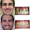 How to get braces for free in ireland. 3
