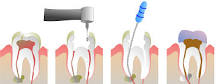 Image result for what to place to close for multi-unit root canal treatment