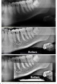 We did not find results for: Pdf An Image Processing Approach Based On Gnu Image Manipulation Program Gimp To The Panoramic Radiography Semantic Scholar