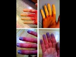 Raynaud S Disease Buerger S Disease Cardiovascular Disorders