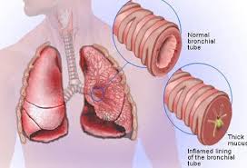 Image result for Acute Bronchitis