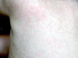 Viral rashes usually go away after a few days, but may last up to 2 weeks. Roseola Rash Pictures Symptoms And Treatments