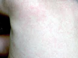 Roseola (erythema subitum, due to herpesvirus 6). Roseola Rash Pictures Symptoms And Treatments