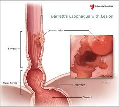 Image result for esophagus