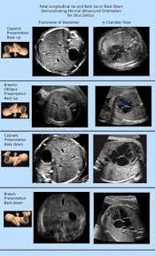 Image Result For Fetal Presentation On Ultrasound Obstetric Ultrasound Ultrasound Ultrasound Sonography