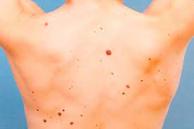 The skin cancer foundation recommends everyone see a dermatologist annually for a professional skin exam. How To Tell If Moles Are Skin Cancer Teen Vogue