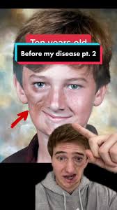 Young vs. Old Me: Parry Romberg Syndrome Journey