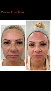 Anyone use plasma for lips lightening?