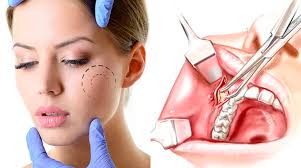 Tudo sobre a bichectomia o que é o nome estranho é a nova moda em cirurgia plástica para afinar o rosto. Bichectomia Clinica Rinofacial