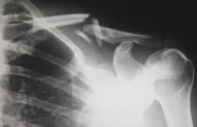 If you've got a broken bone there's no reason to wait around for er staff to find the time for you. Where Should I Go For An X Ray