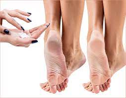 How long do cracked heels take to heal? How To Fix Cracked Heels Foot Com