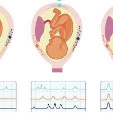 False Labor False Alarms And How To Tell If You Re In Prodromal Labor