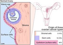 At surgery, it looks the same as an epithelial ovarian cancer that has spread through the abdomen. Types Of Ovarian Tumors Ovarian Cancer Johns Hopkins Pathology