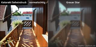 Grauer Star Symptome Ursache Behandlung Op Lasikon