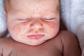 Image result for red rash face