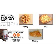 Pesakit yang menghadapi masalah ini selalunya akan diberikan ubat. Kidney Stone Remove Rumusan Homeopati Untuk Pesakit Batu Karang Shopee Malaysia