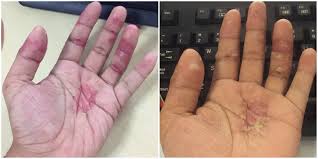 Maksud air mazi air mazi ialah cecair jernih yang keluar disebabkan rangsangan ketika berada air mazi ini sering di sebut sebagai 'gel pelincir' di kalangan pasangan yang telah berkahwin dan suka. Lelaki Kongsi Derita Dyshidrotic Eczema