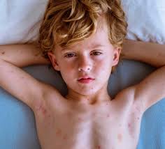 Image result for shingles in children