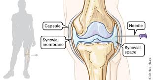 Quels sont les symptômes de l'arthrose du genou ? Injection Dans L Articulation Du Genou
