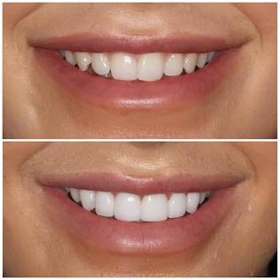 Veneers Before and After, AI generated