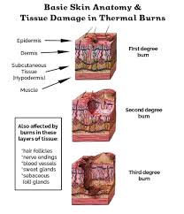 Learn The Burn A Guide To Skin Burns Pizza Equipment Pros