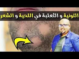 التخلص من الثعلبة و التونية في الشعر و القشرة الكثيرة مشاكل فروة الرأس مع الدكتور عماد ميزاب youtube pandora screenshot