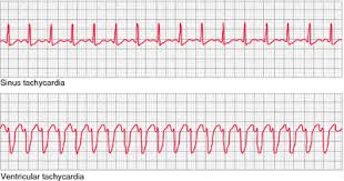 Supraventricular tachycardia (svt) means that from time to time your heart beats very fast for a reason other than exercise, high fever, or stress. Supraventricular Tachycardia Definition Of Supraventricular Tachycardia By Medical Dictionary