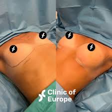 Image result for Breast Augmentation