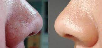 Di antara pertanyaan yang ditanyakan adalah: 6 Petua Hilangkan Blackhead Whitehead Dengan Bahan Semula Jadi Nurraysa